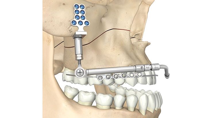 csm_Adjustable_Maxillary_Distractor_04_0929f66687
