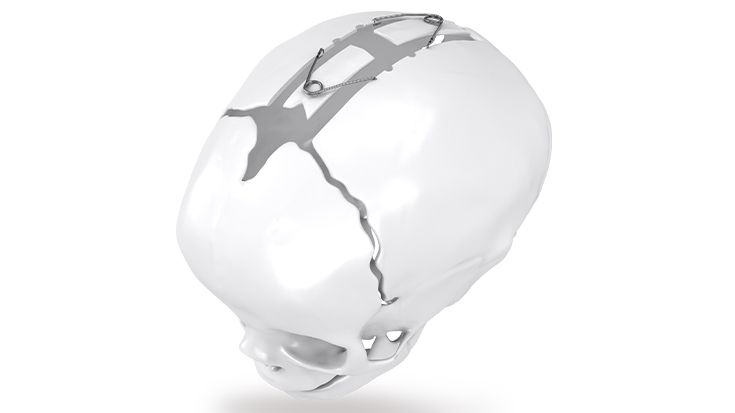 csm_Cranioxpand_Skull_735x413px_62c36b5dd4