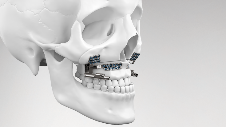 csm_Hyperdrive_Maxillary_Distractor_735x413px_5c6a13dc46
