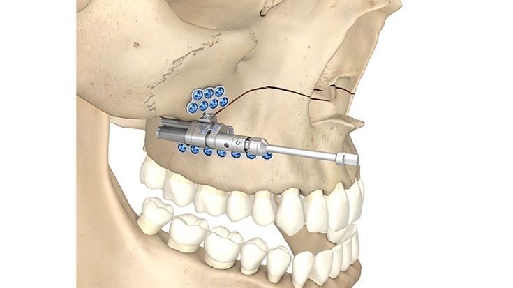 csm_Maxillary_Telescoping_Distractor_04_5d73e15fc4
