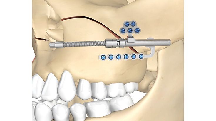 csm_Zurich_Pediatric_Maxillary_Distractor_04_be96da116a